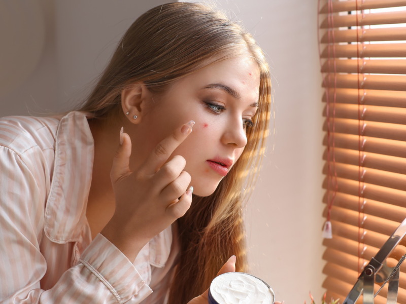 Eight Effective Home Remedies to Get Rid of Acne